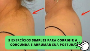 5 exercícios simples para corrigir a corcunda e arrumar sua postura